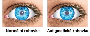 zakriveni-rohovky-astigmatismus